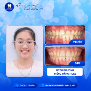Uyên Phương - Niềng Răng Mắc Cài Kim Loại