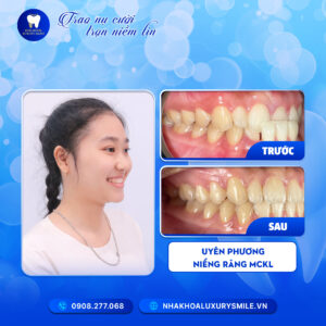 Uyên Phương - Niềng Răng Mắc Cài Kim Loại