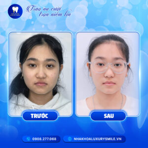 Uyên Phương - Niềng Răng Mắc Cài Kim Loại