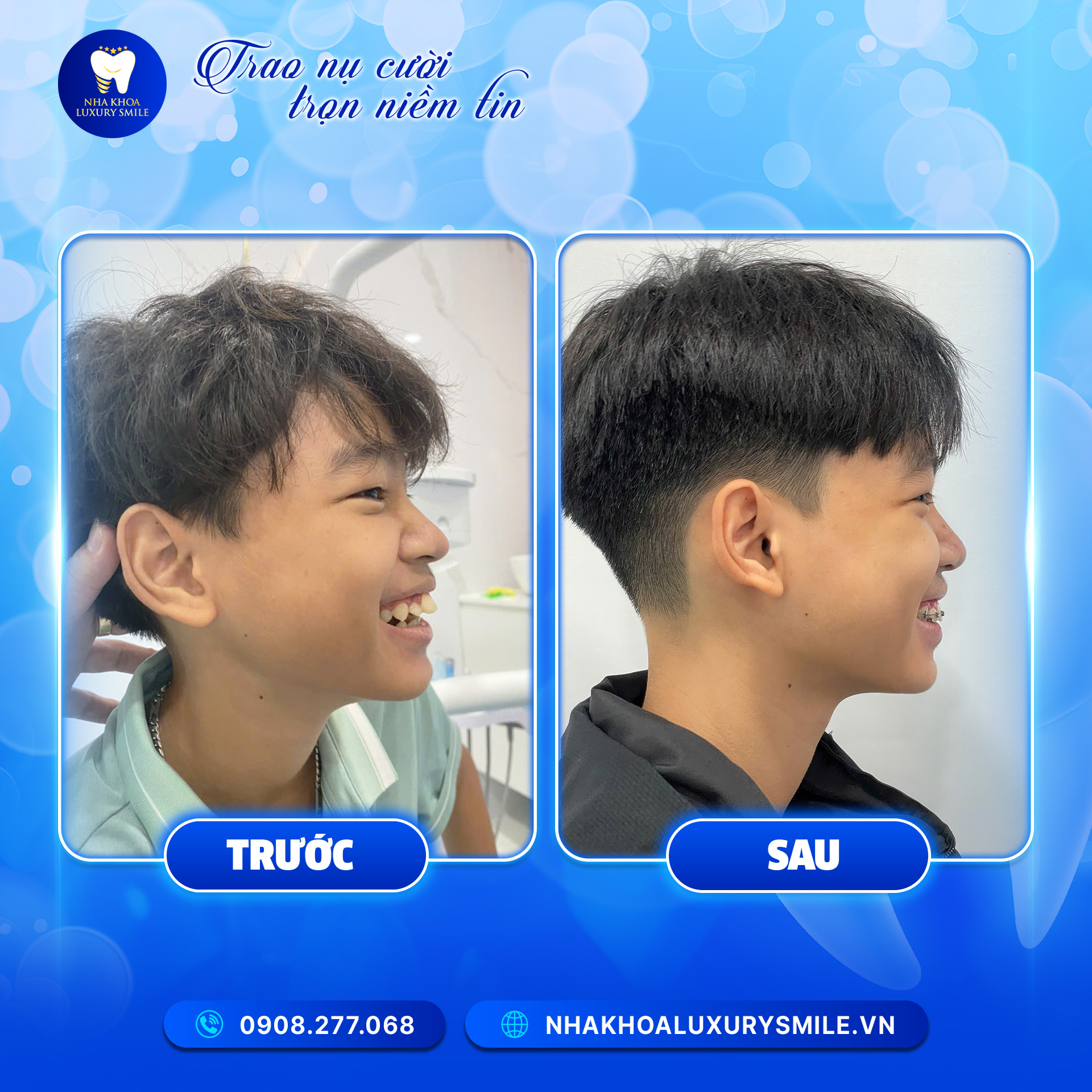 Kết quả thay đổi của Trường Long - 14 tuổi sau 1 năm niềng răng