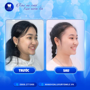 Uyên Phương - Niềng Răng Mắc Cài Kim Loại
